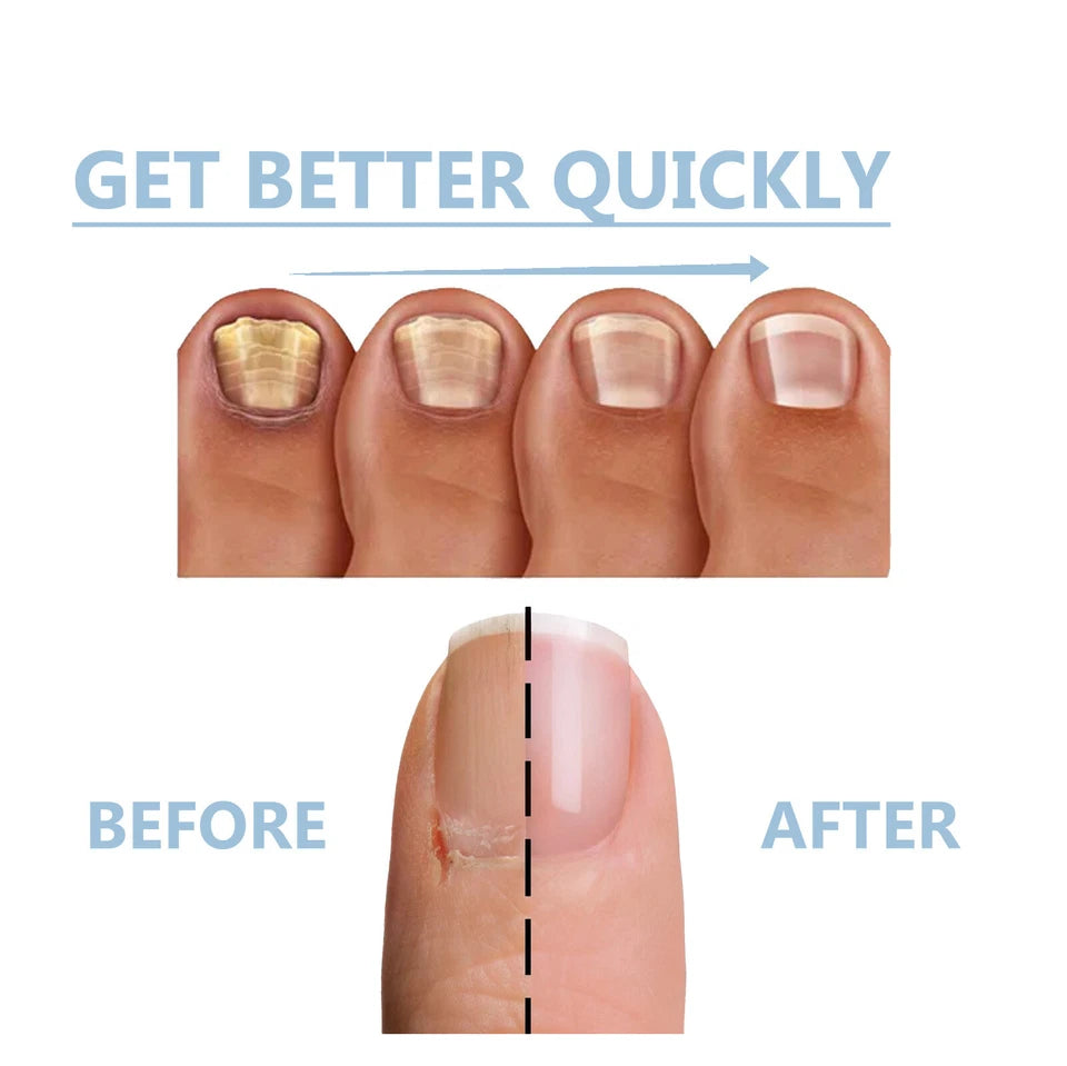 OceAura 2-Pack Nail Guard - Nail Growth and Repair Serum 15ml x2 - Nail Strengthening & Conditioning Serum
