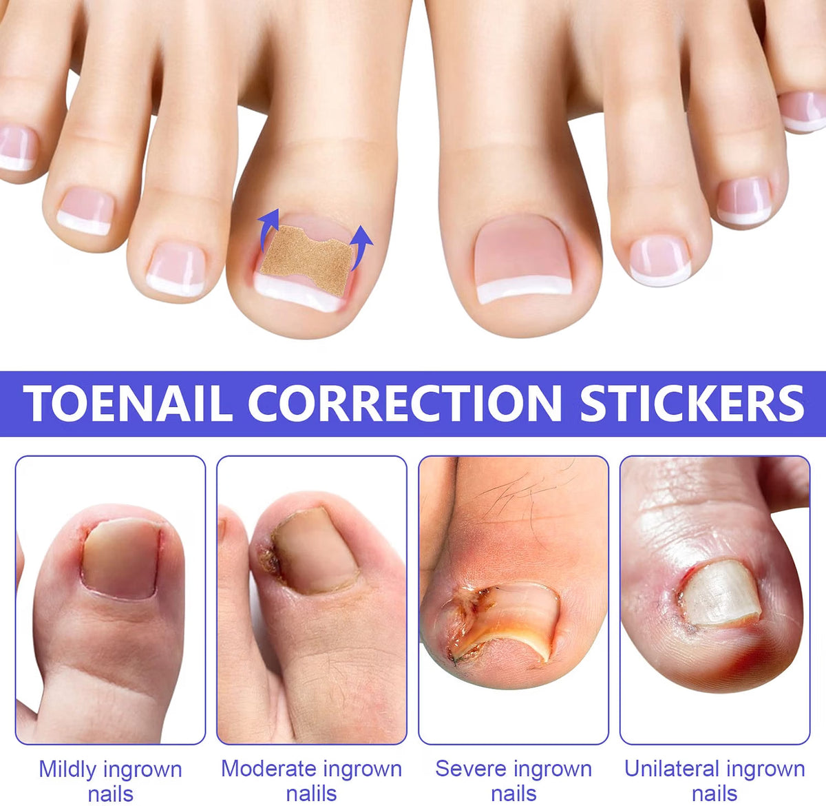 Sefudun Ingrown Toenail Correction Patches - 100PCS Elastic Corrector Stickers - No-Glue Toenail Care Strips