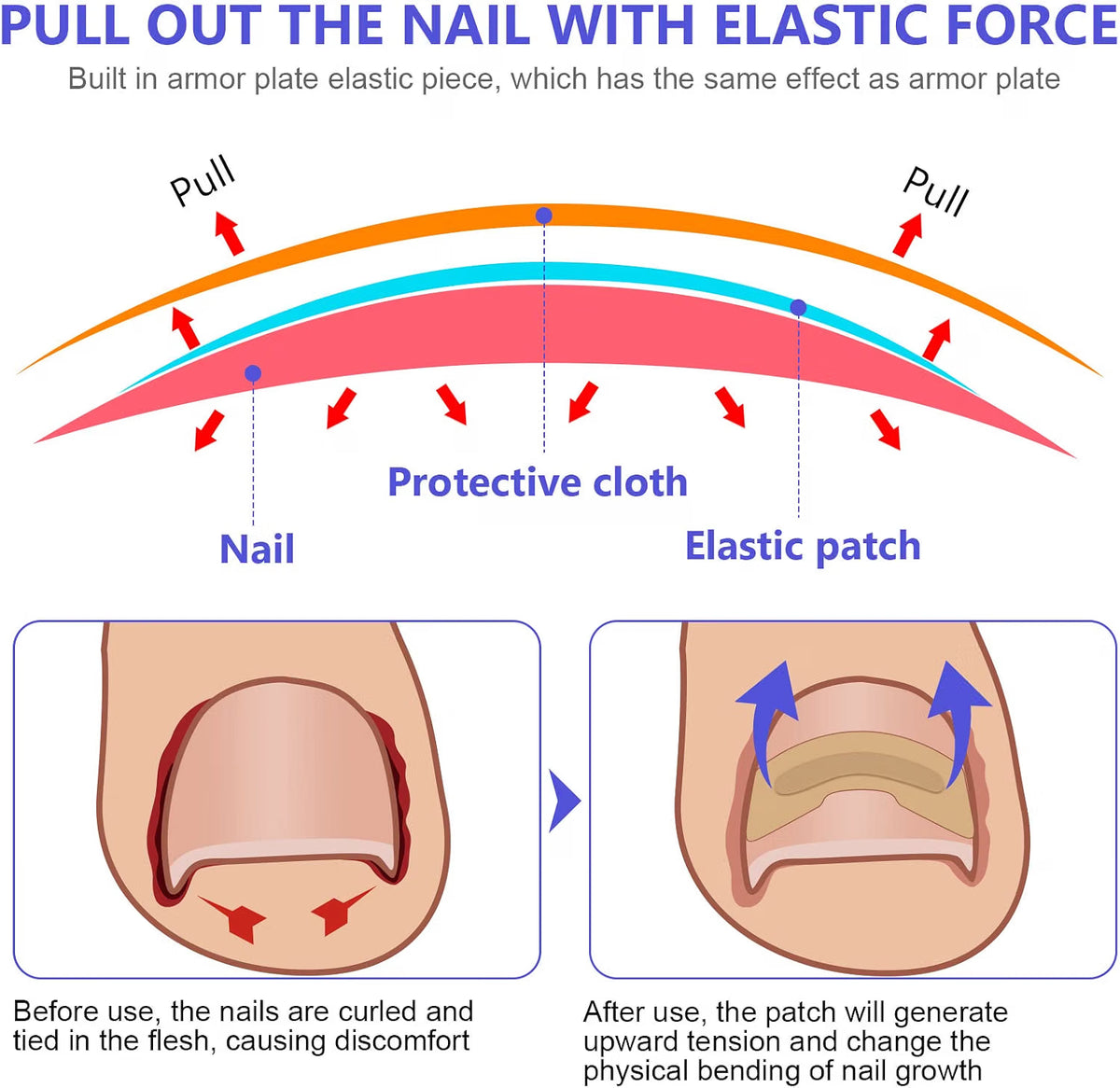 Sefudun Ingrown Toenail Correction Patches - 100PCS Elastic Corrector Stickers - No-Glue Toenail Care Strips