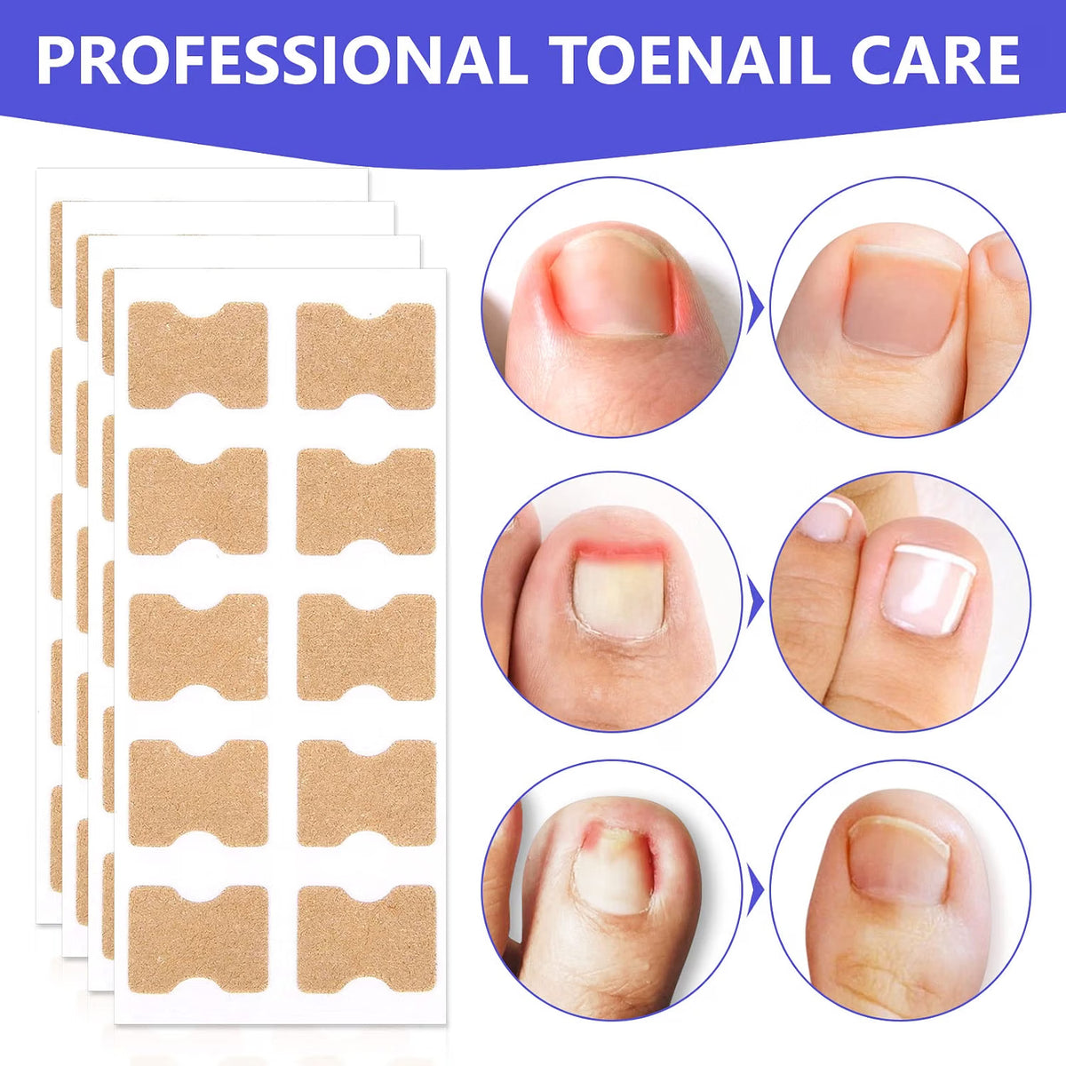 Sefudun Ingrown Toenail Correction Patches - 100PCS Elastic Corrector Stickers - No-Glue Toenail Care Strips