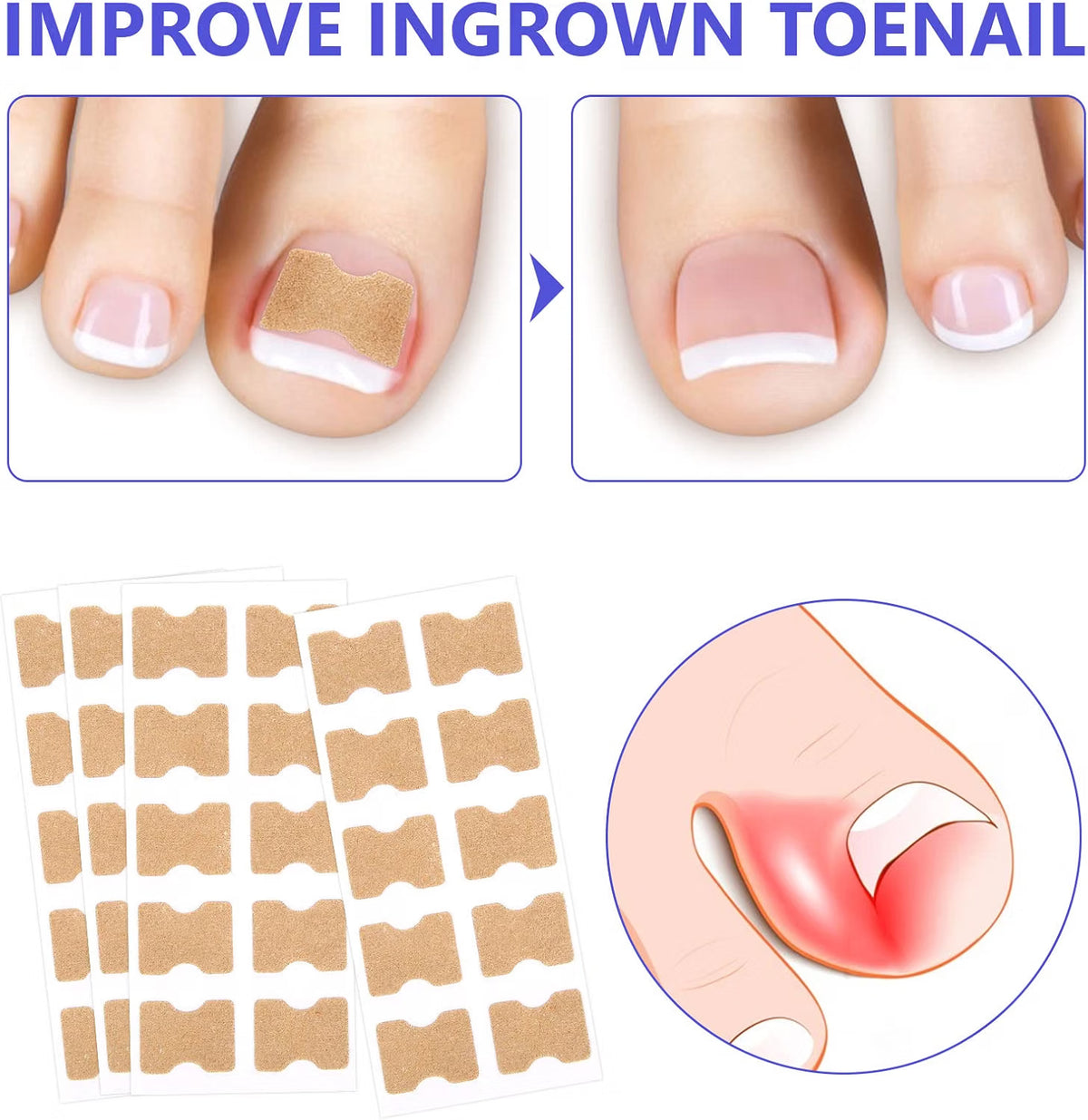 Sefudun Ingrown Toenail Correction Patches - 100PCS Elastic Corrector Stickers - No-Glue Toenail Care Strips