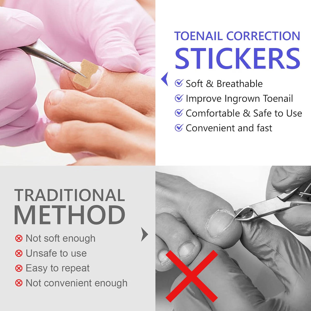 Sefudun Ingrown Toenail Correction Patches - 100PCS Elastic Corrector Stickers - No-Glue Toenail Care Strips